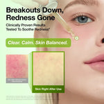 Dropper applying Anua Azelaic Acid Serum to cheek next to an inset photo showing immediate reduction in skin redness
