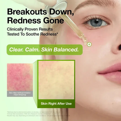 Dropper applying Anua Azelaic Acid Serum to cheek next to an inset photo showing immediate reduction in skin redness