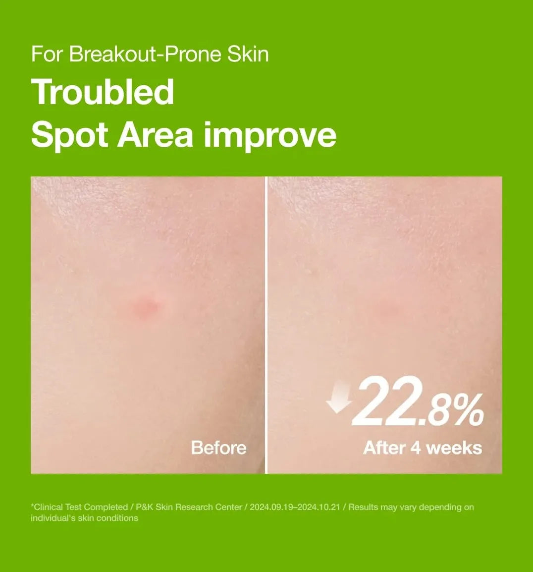 Before and after 4-week clinical result showing 22.8% reduction in red acne spot area using Anua Azelaic Acid Serum