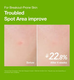 Before and after 4-week clinical result showing 22.8% reduction in red acne spot area using Anua Azelaic Acid Serum