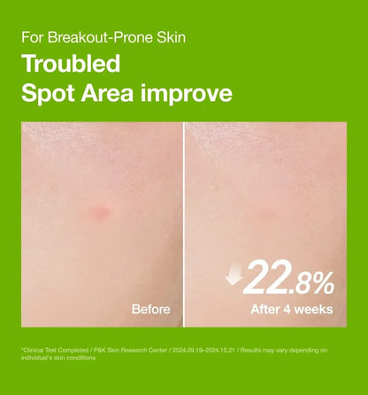 Before and after 4-week clinical result showing 22.8% reduction in red acne spot area using Anua Azelaic Acid Serum