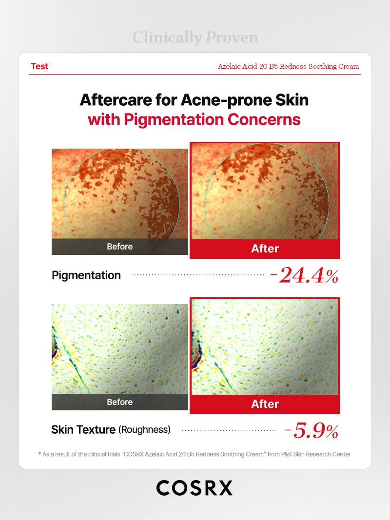 Azelaic Acid 20 B5 Redness Soothing Cream 30ml