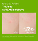 Before and after 4-week clinical result showing 22.8% reduction in red acne spot area using Anua Azelaic Acid Serum