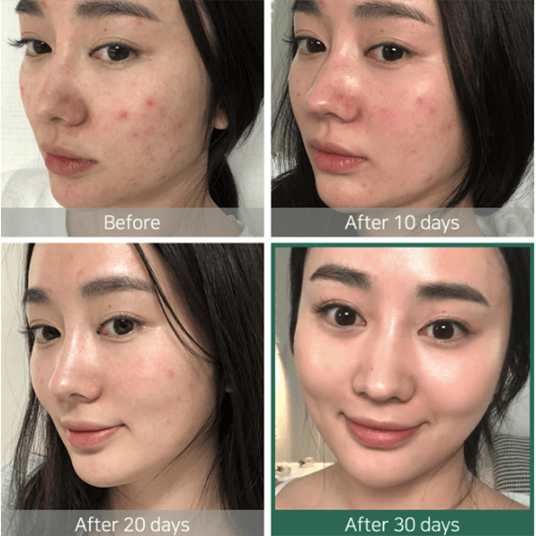 Before and after 30-day skin progress photos showing reduced redness and clearer skin using mixsoon Bean Cream.