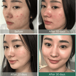 Before and after 30-day skin progress photos showing reduced redness and clearer skin using mixsoon Bean Cream.