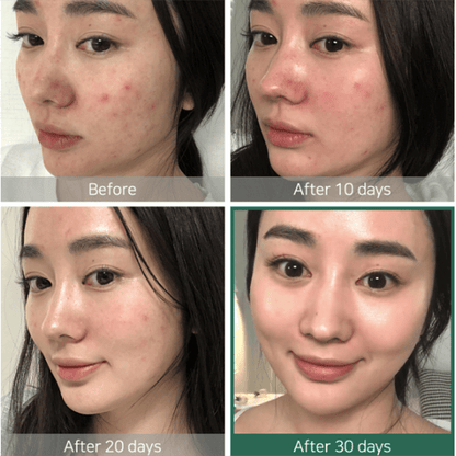 Before and after 30-day skin progress photos showing reduced redness and clearer skin using mixsoon Bean Cream.