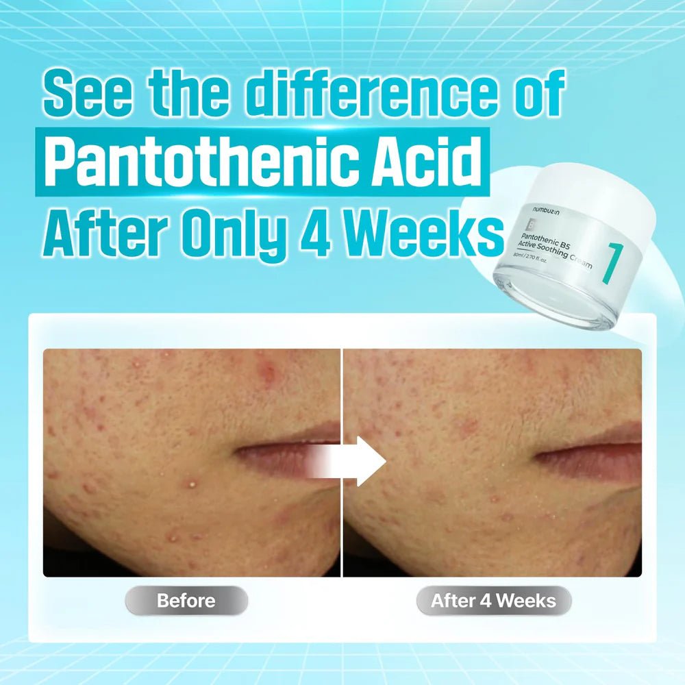 Before and after comparison showing reduced acne after 4 weeks of using Numbuzin No.1 Cream.