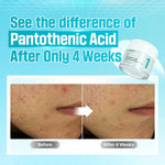 Before and after comparison showing reduced acne after 4 weeks of using Numbuzin No.1 Cream.