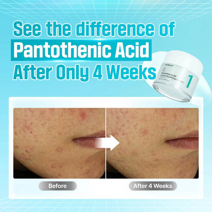 Before and after comparison showing reduced acne after 4 weeks of using Numbuzin No.1 Cream.