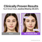Before and after profile view showing the lifting effect on the jawline after 40 minutes.