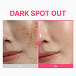 Skincare before and after results showing visible reduction in dark spots and freckles on the cheek.